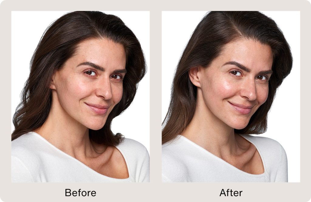 Before and after skinvive treatment